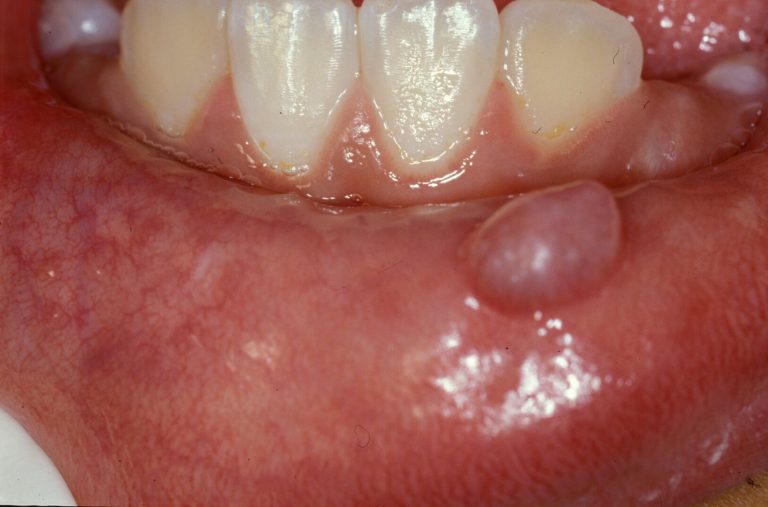 A Guide to Oral Mucocele Cysts