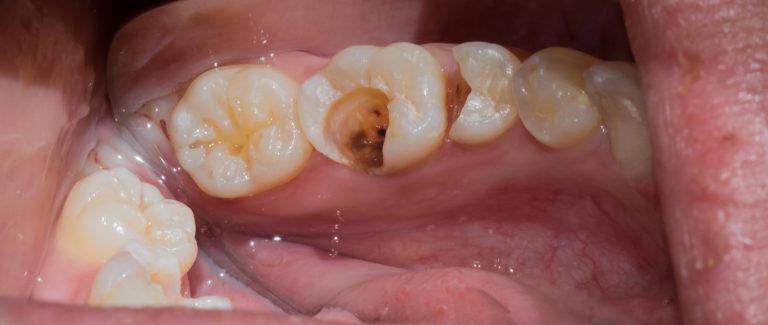 All About Tooth Decay