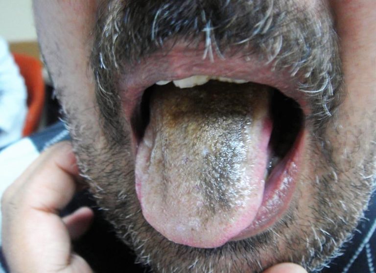 Black Hairy Tongue