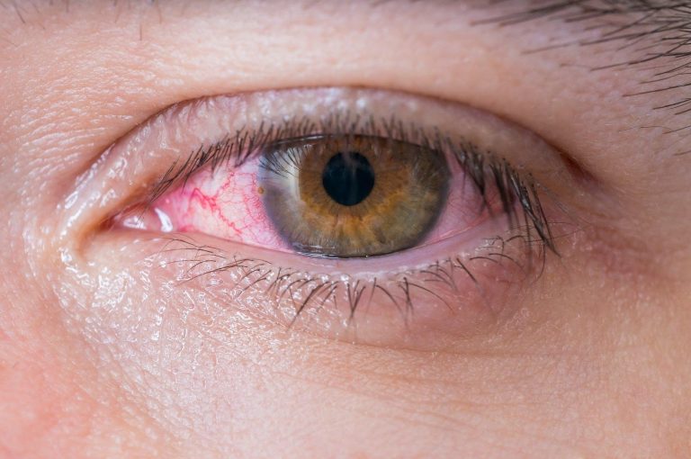 Between Allergies and Blurry Vision