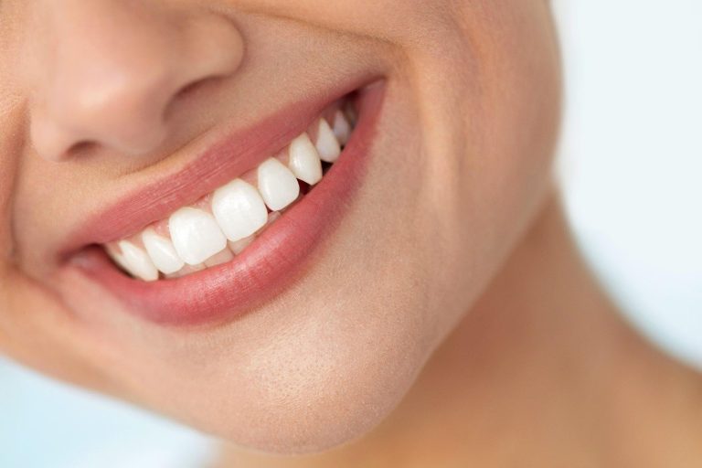Braces to Veneers