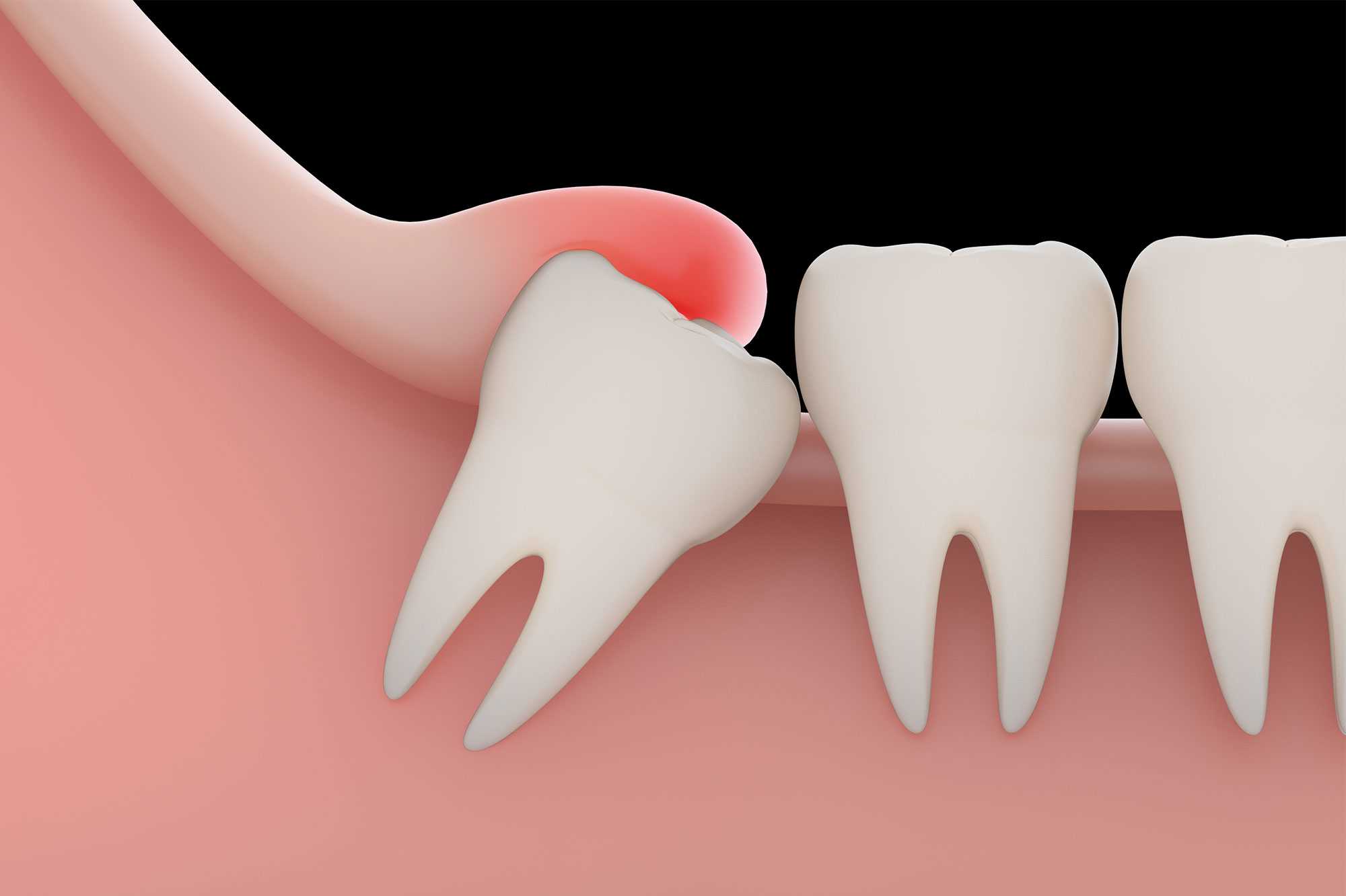Wisdom Teeth Extraction