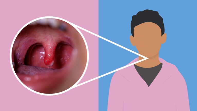 Sore Throat