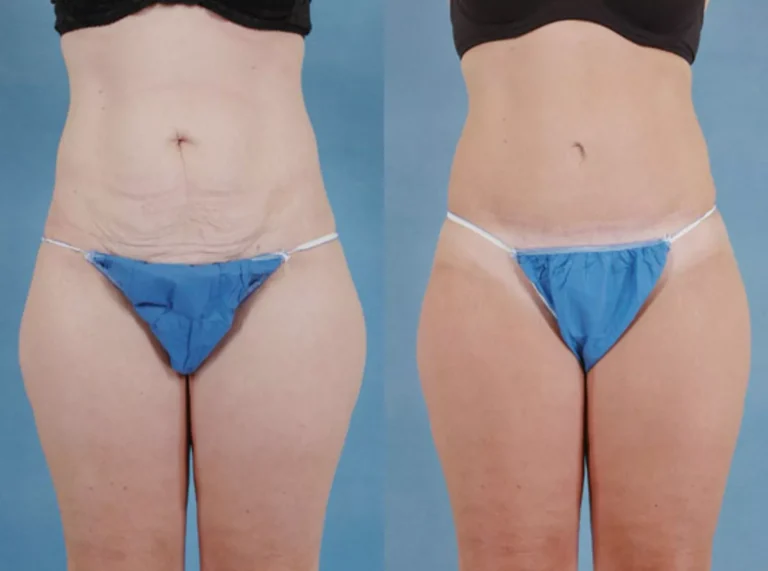 Tummy Tuck